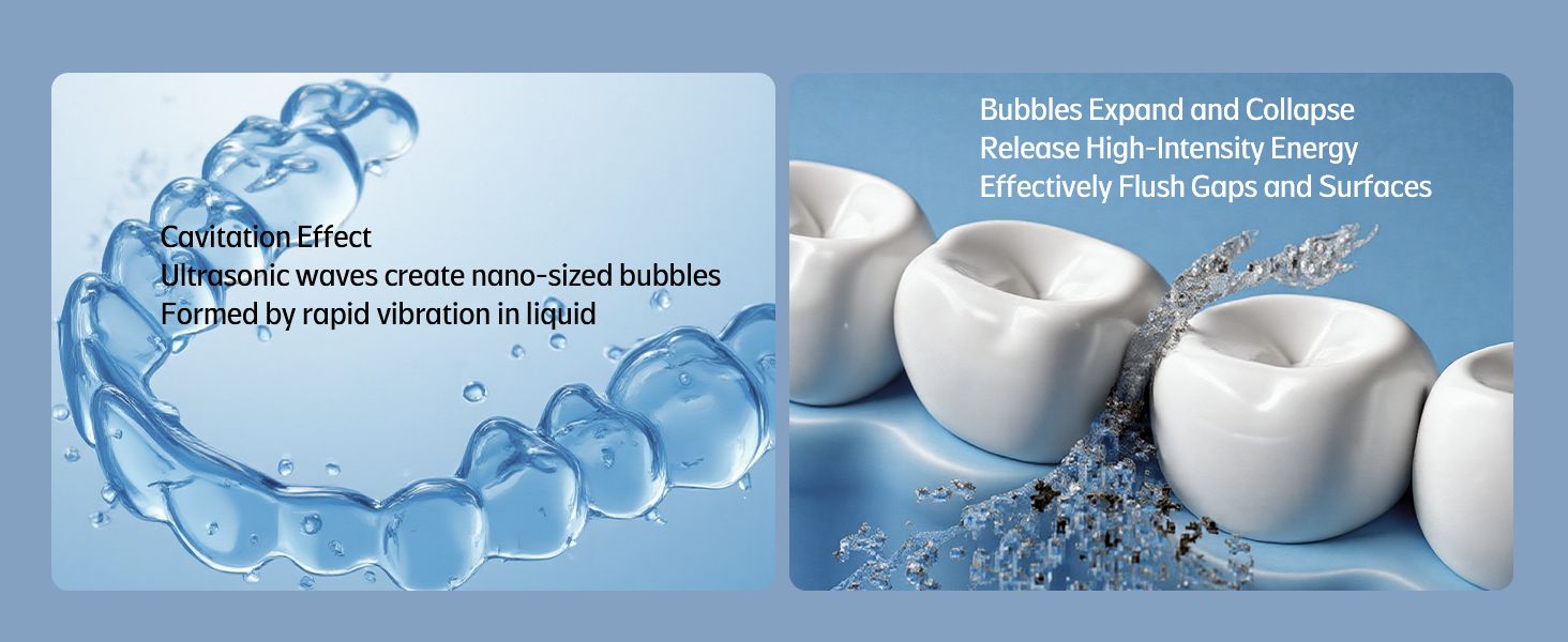 Ultrasonic cavitation bubbles cleaning an aligner and teeth